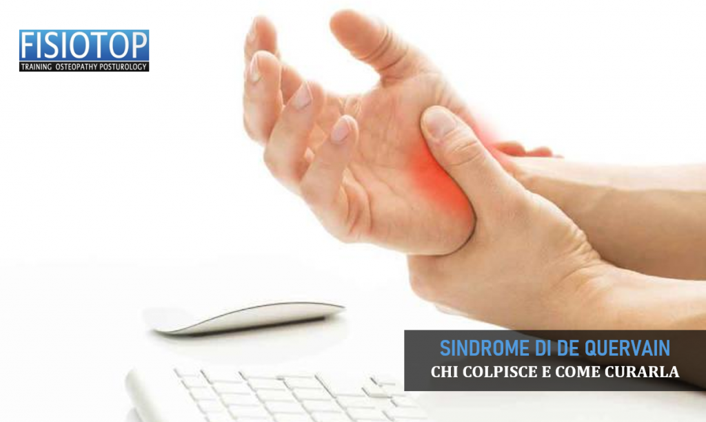 Sindrome di de quervain